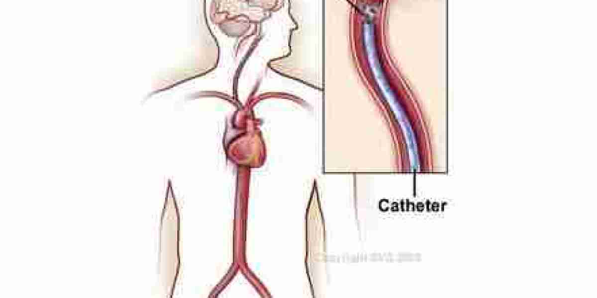 The Role of Thrombolysis in Deep Vein Thrombosis Treatment