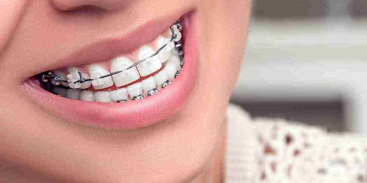 Damon Braces: Are They Worth It?